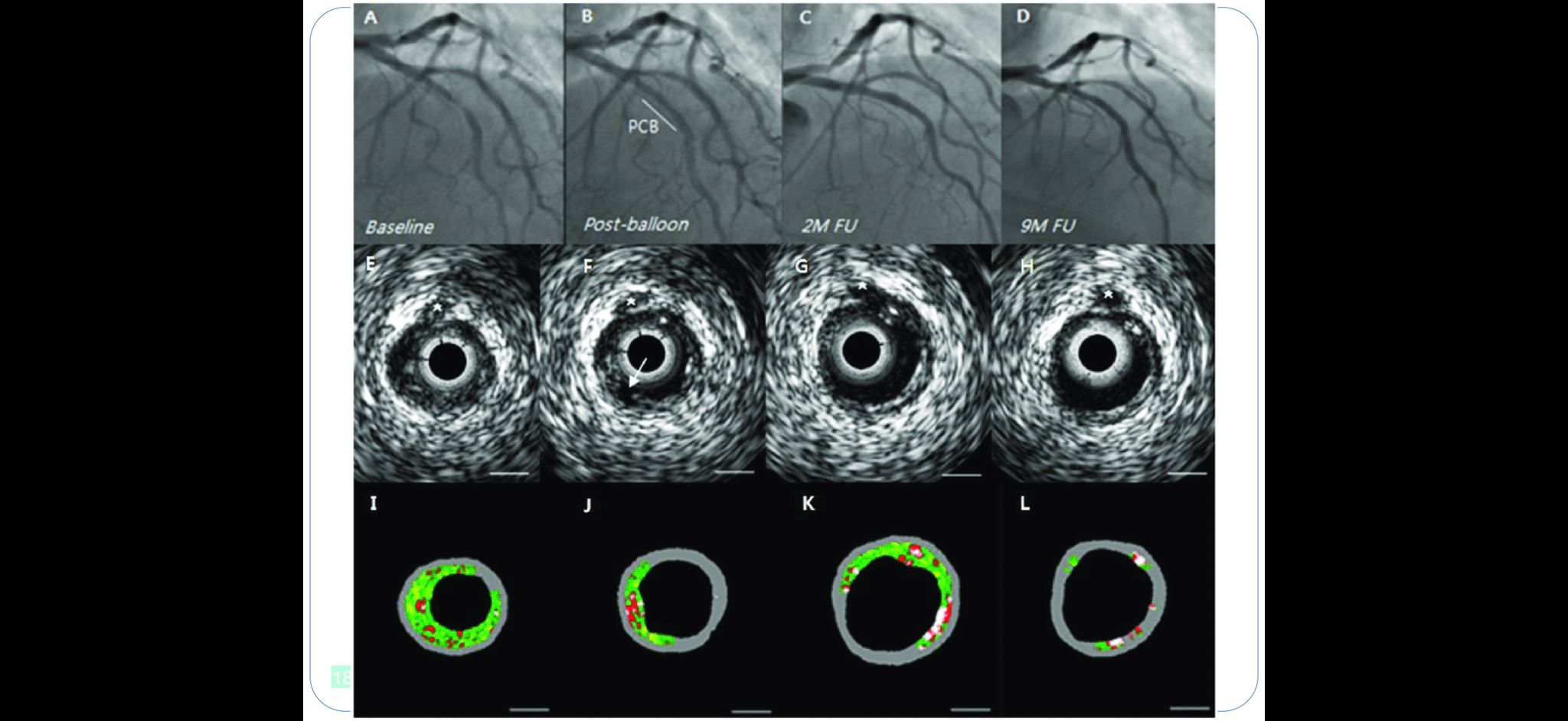 Positive Vessel Remodeling and Late Lumen Enlargement — DCB clinical outcome